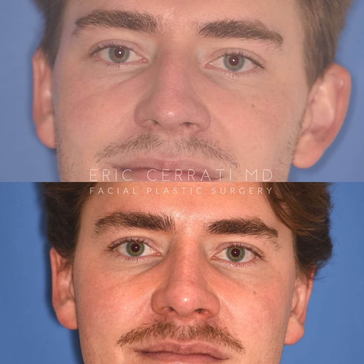 Rhinoplasty + Left Otoplasty before and after - before