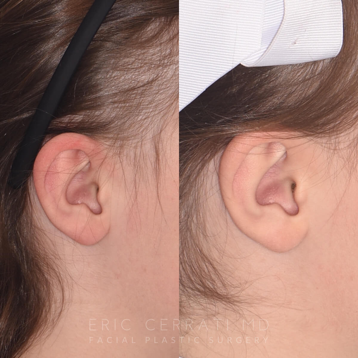 Otoplasty before and after - after