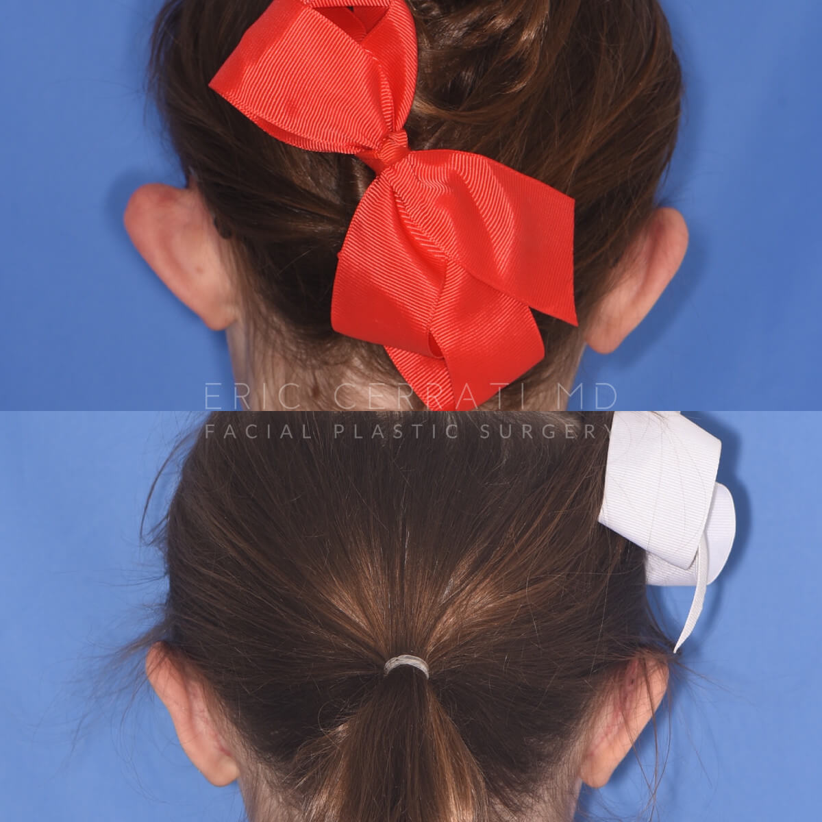 Otoplasty before and after - before