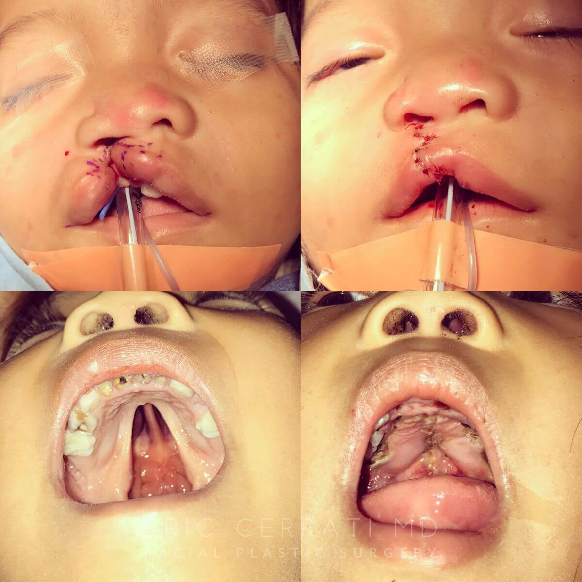 Cleft Lip and Palate Repair before and after - before