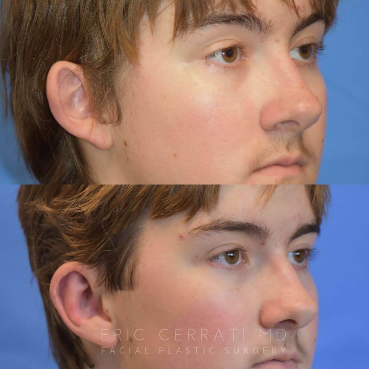 Bilateral Otoplasty before and after - after