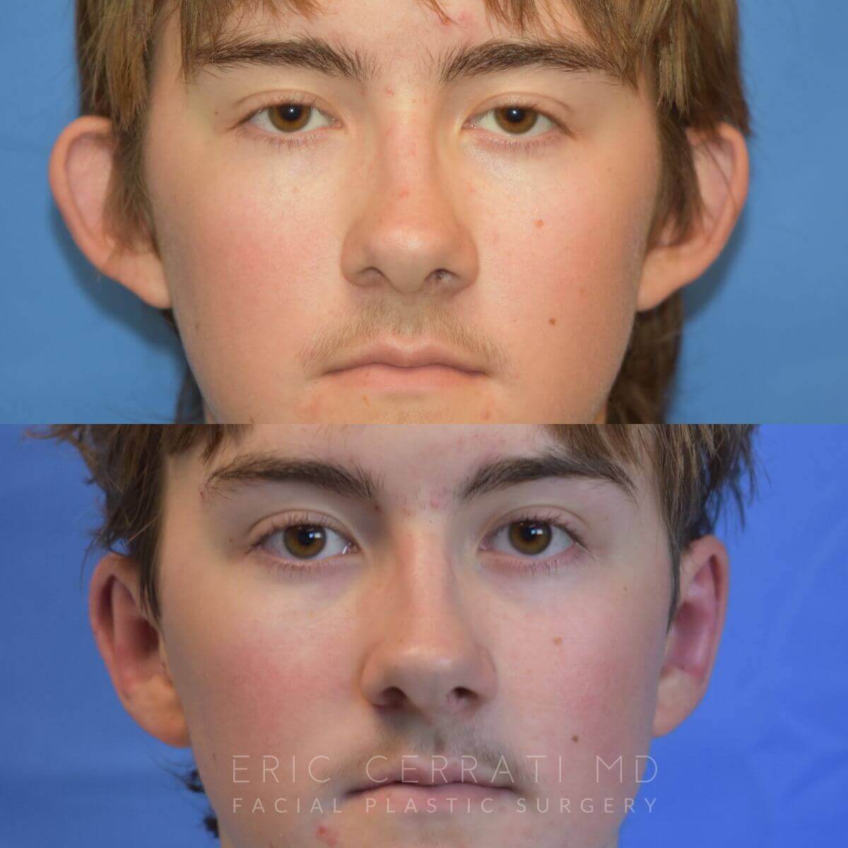 Bilateral Otoplasty before and after - before