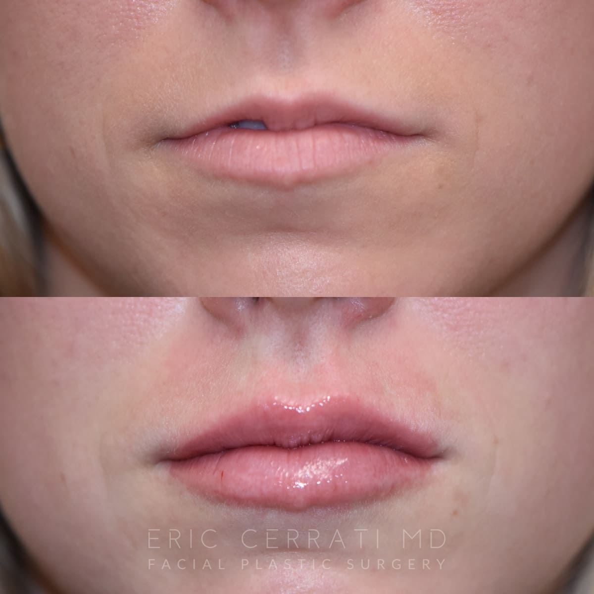 Lip Filler before and after - before