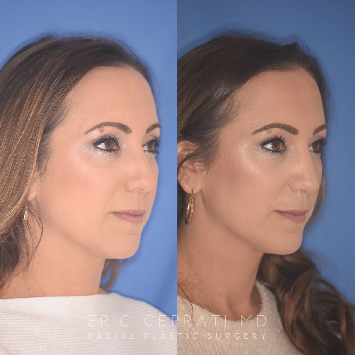 Rhinoplasty + Chin Implant before and after - after