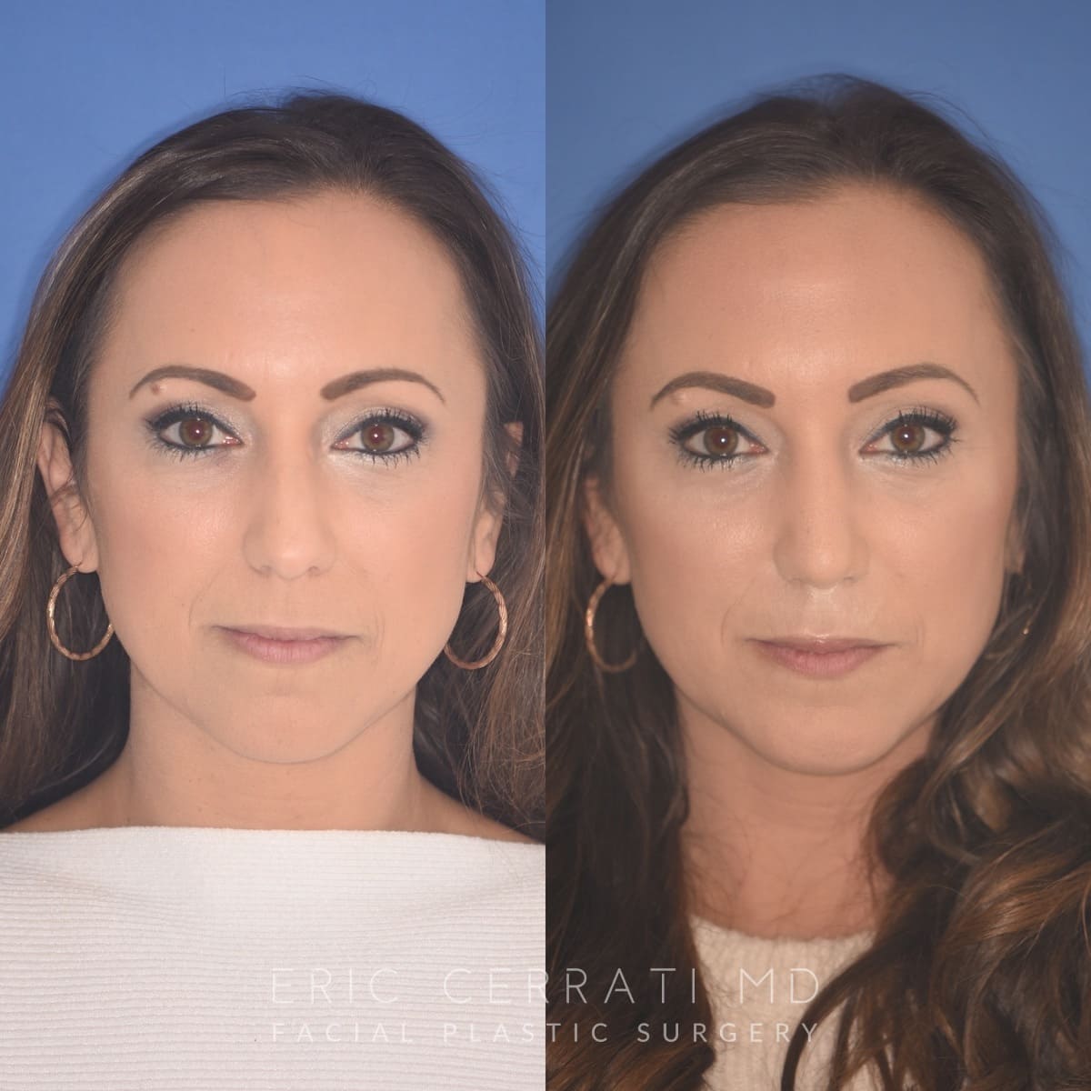 Rhinoplasty + Chin Implant before and after - before