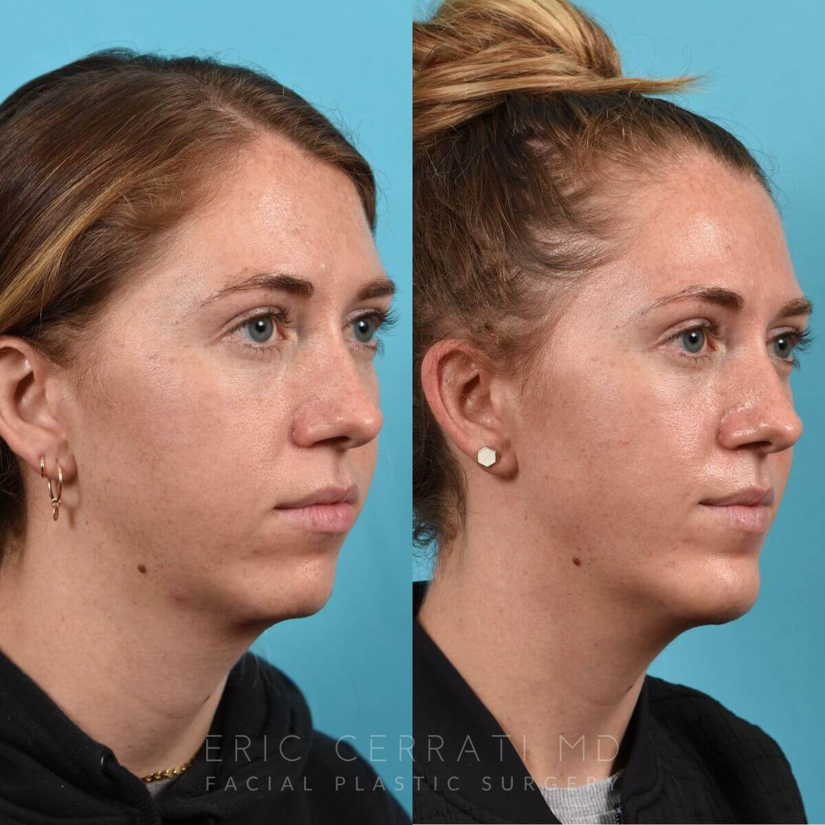 Chin Implant before and after - after