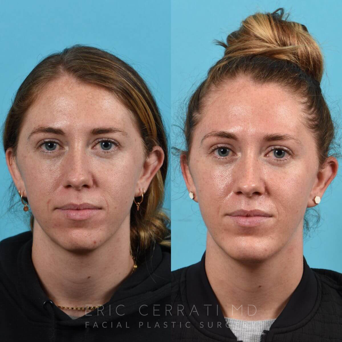 Chin Implant before and after - before