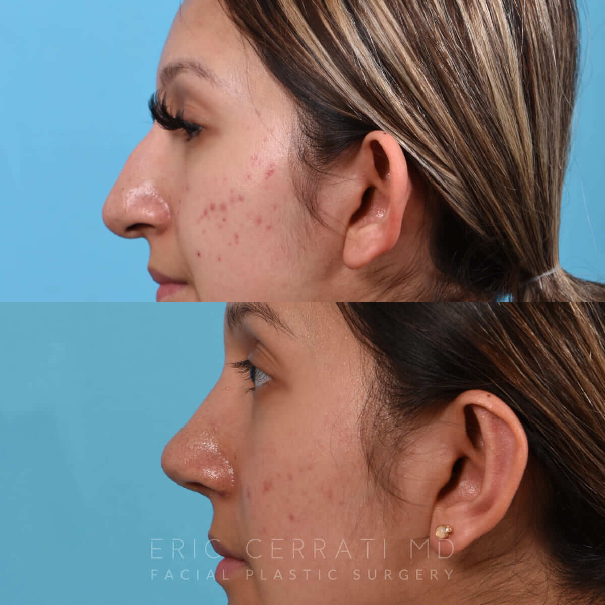 Bilateral Otoplasty before and after - after