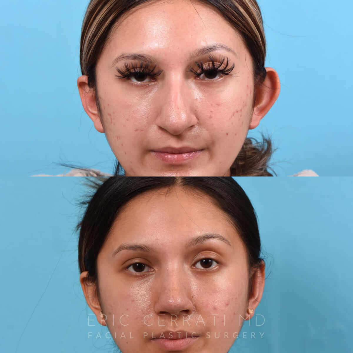 Bilateral Otoplasty before and after - before