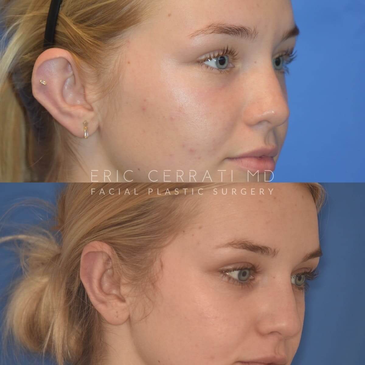 Otoplasty before and after - after