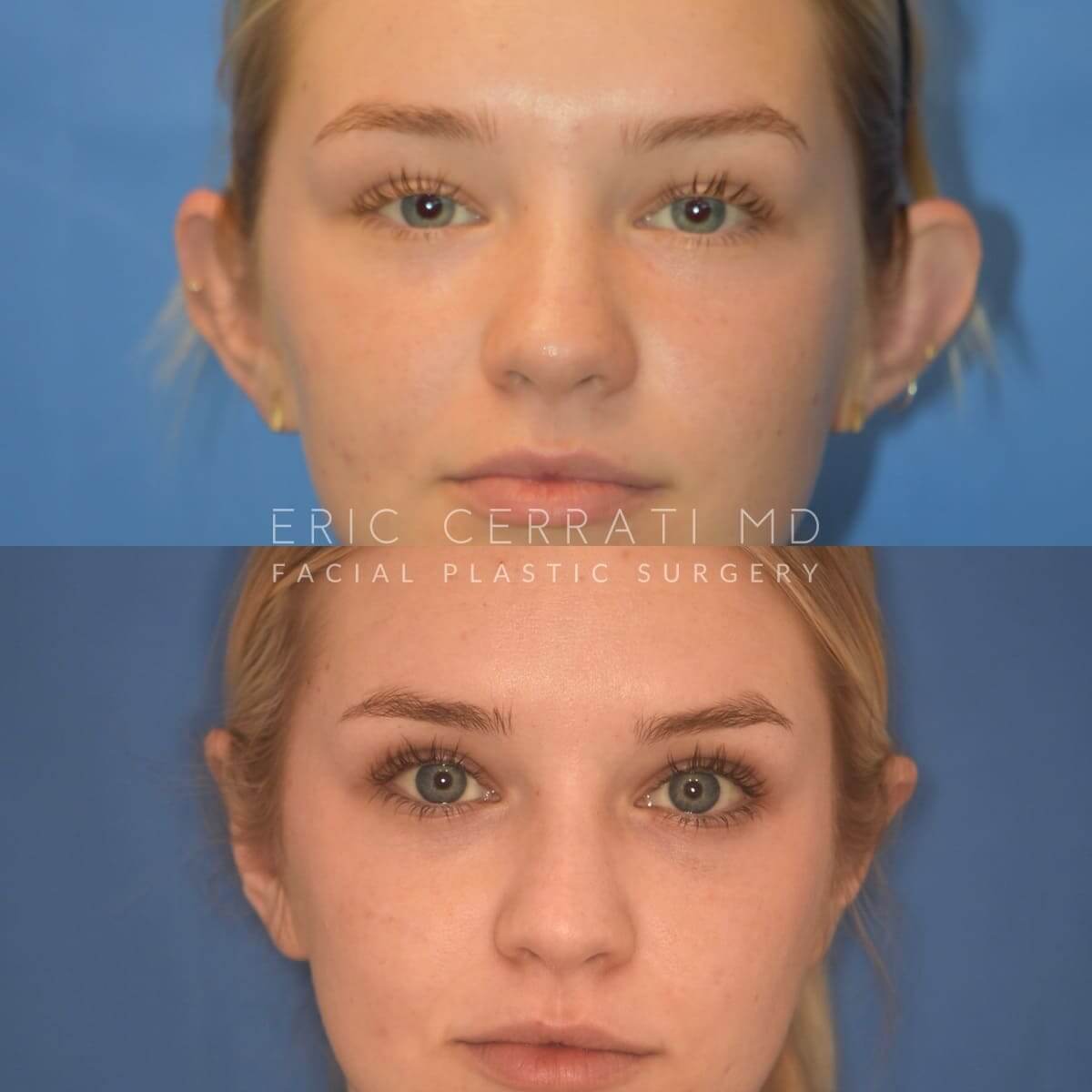 Otoplasty before and after - before