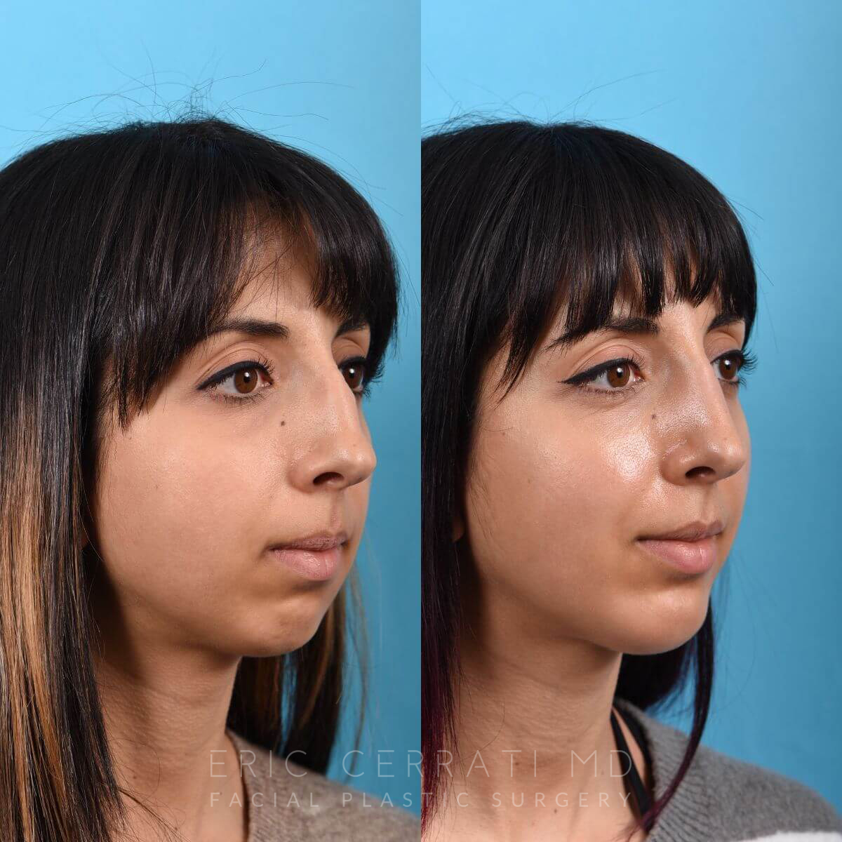 Rhinoplasty + Chin Implant before and after - after