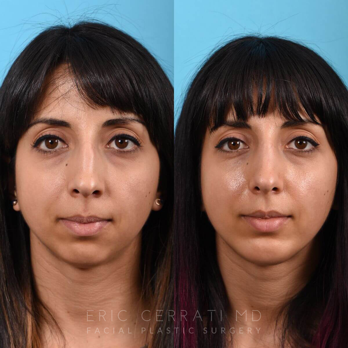 Rhinoplasty + Chin Implant before and after - before