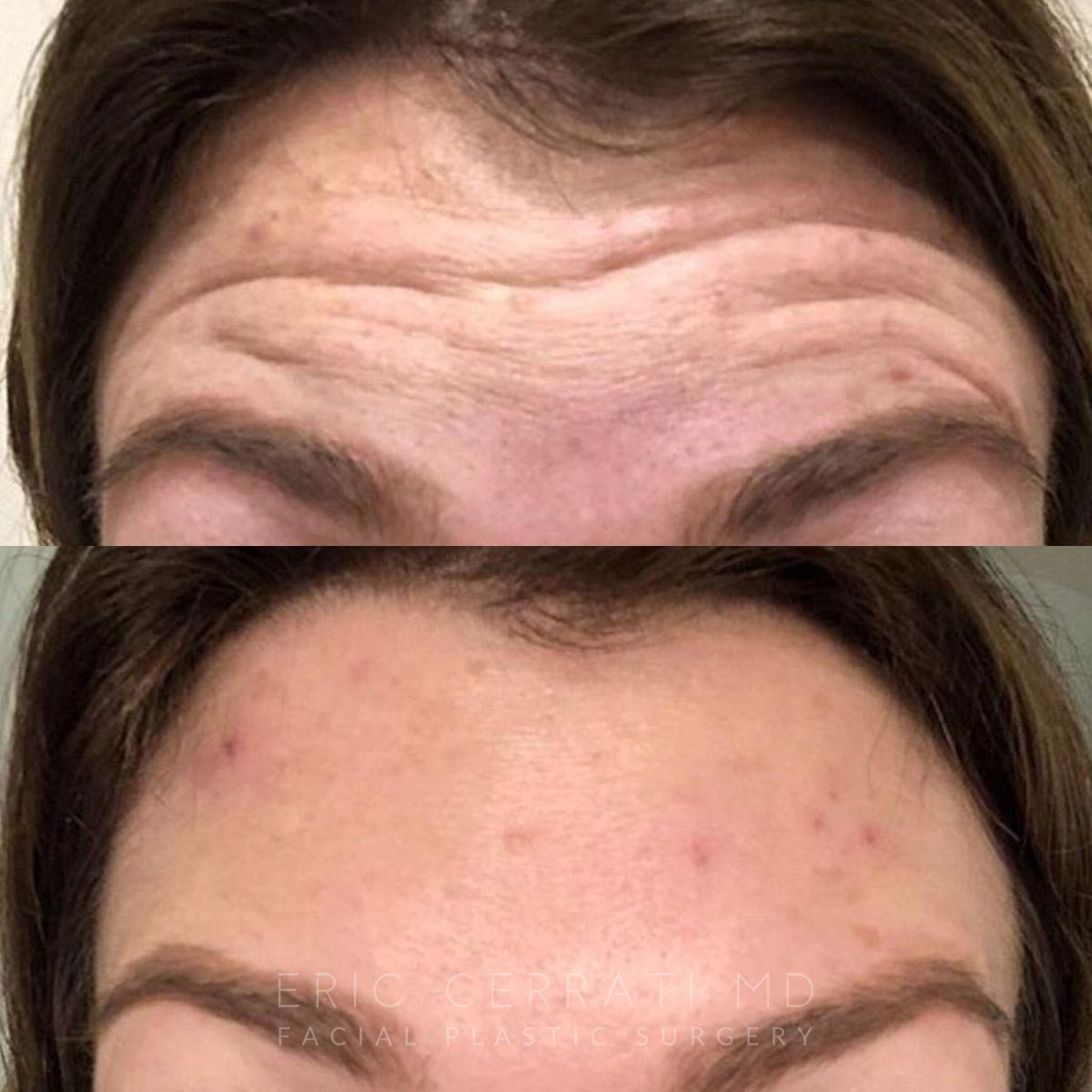Botox before and after - before