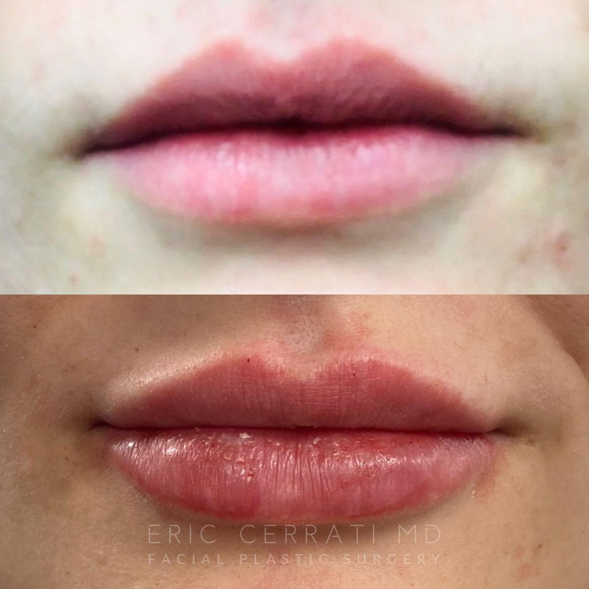 Liquid Facelift before and after - after