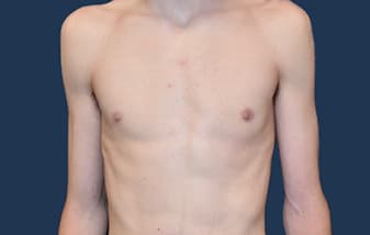Gynecomastia (Male Breast Reduction) before and after - after