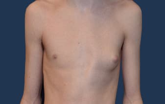 Gynecomastia (Male Breast Reduction) before and after - before