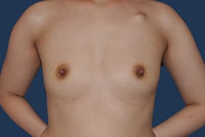 Breast Reconstruction before — Dr. Tommaso Addona