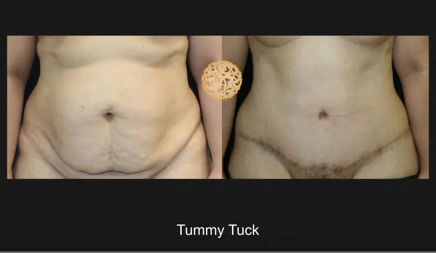 Tummy Tuck before and after - after