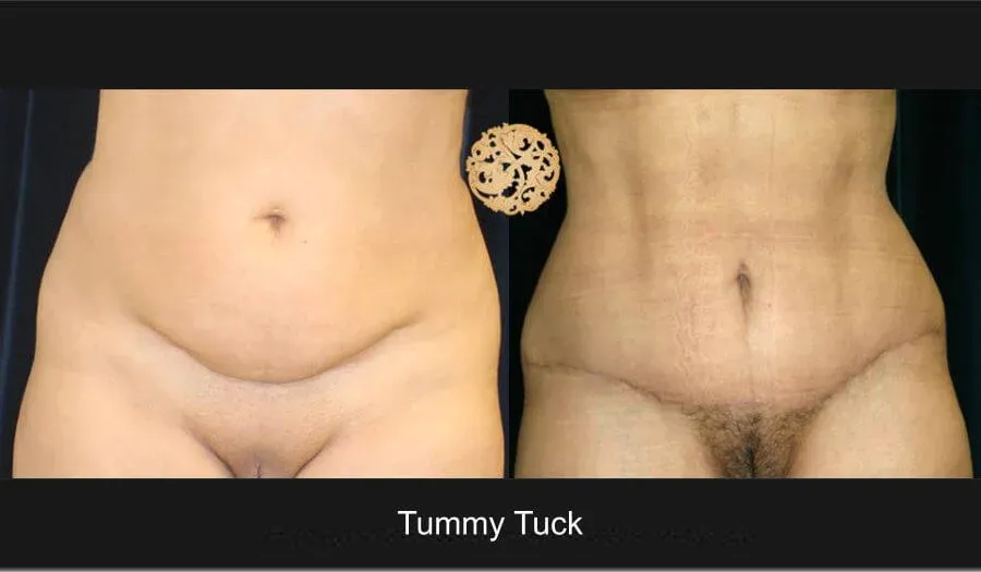 Tummy Tuck before and after - before
