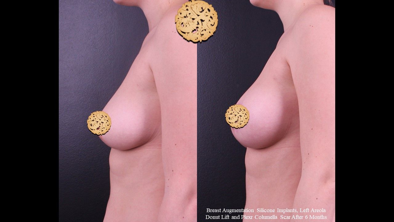 Breast Augmentation before and after - after
