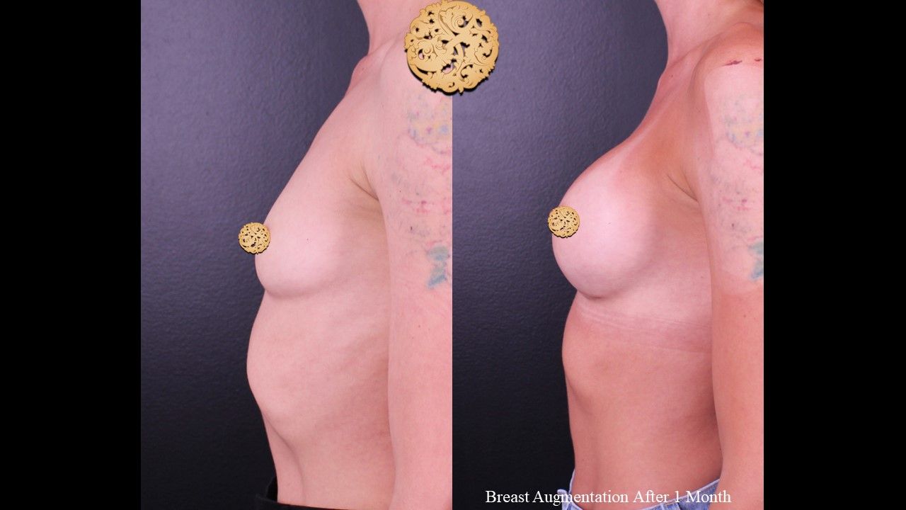 Breast Augmentation before and after - before