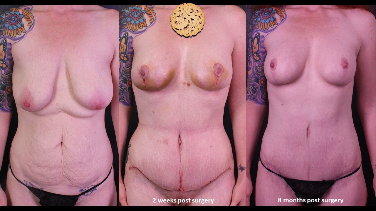 Mommy Makeover before and after - before