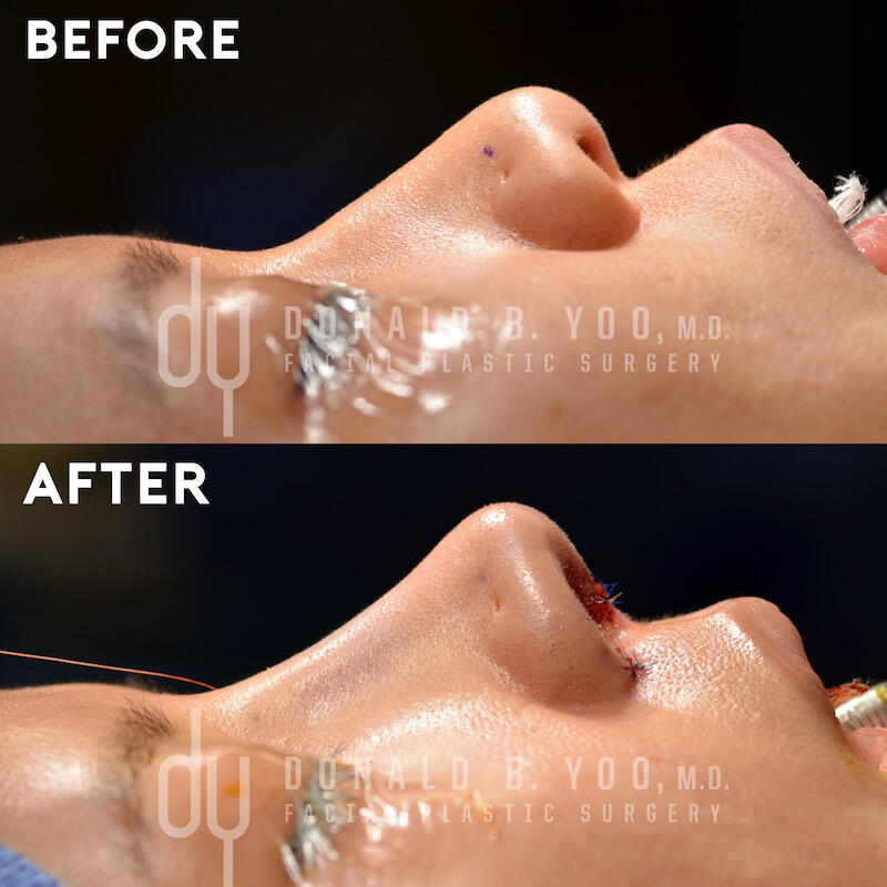Rhinoplasty before and after - after
