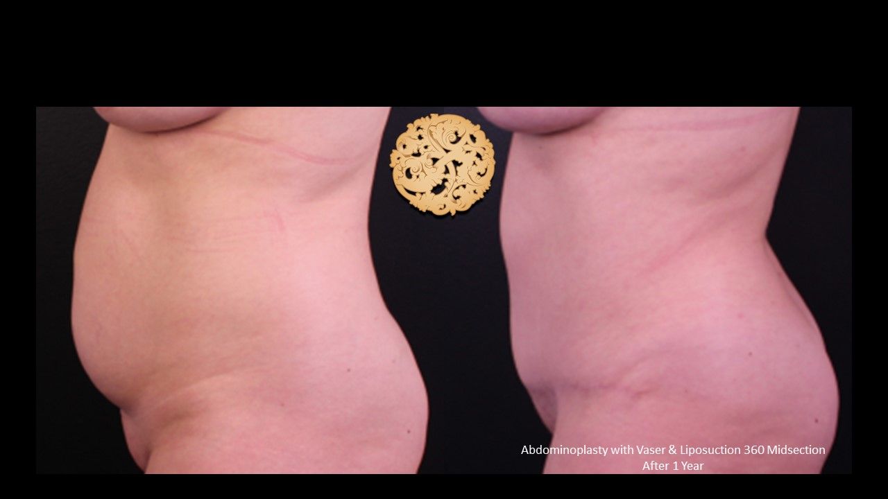 Tummy Tuck before and after - after