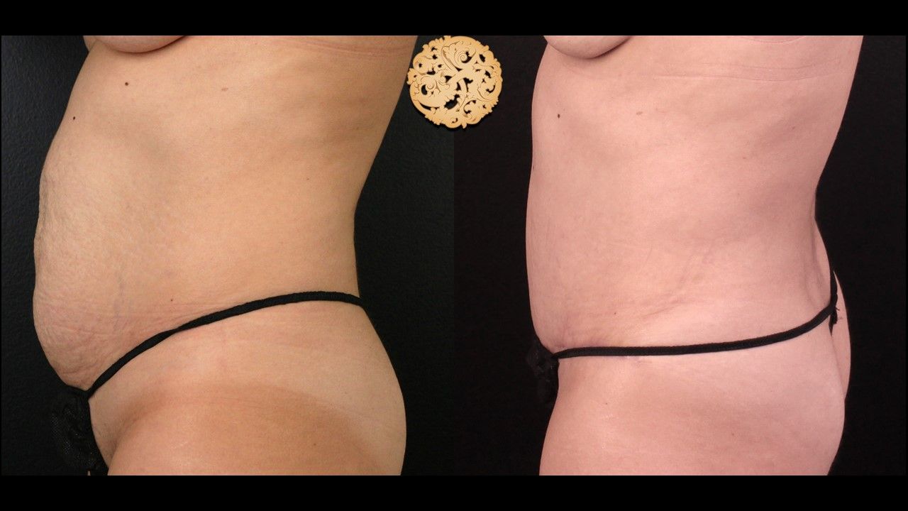 Tummy Tuck before and after - before