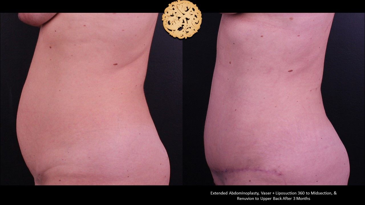 Tummy Tuck before and after - before