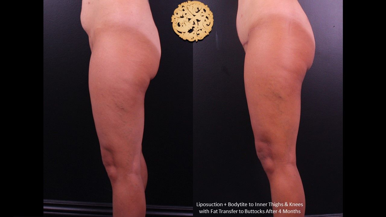 Brazilian Butt Lift before and after - after