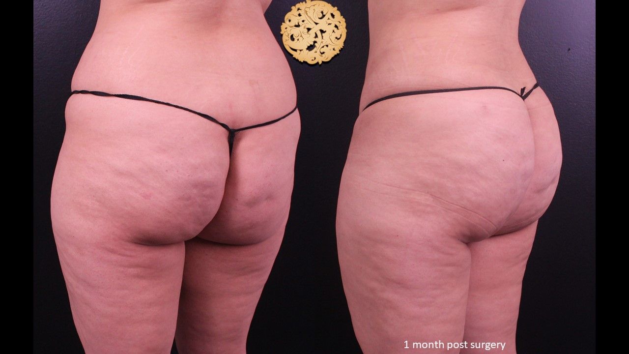 Brazilian Butt Lift before and after - before
