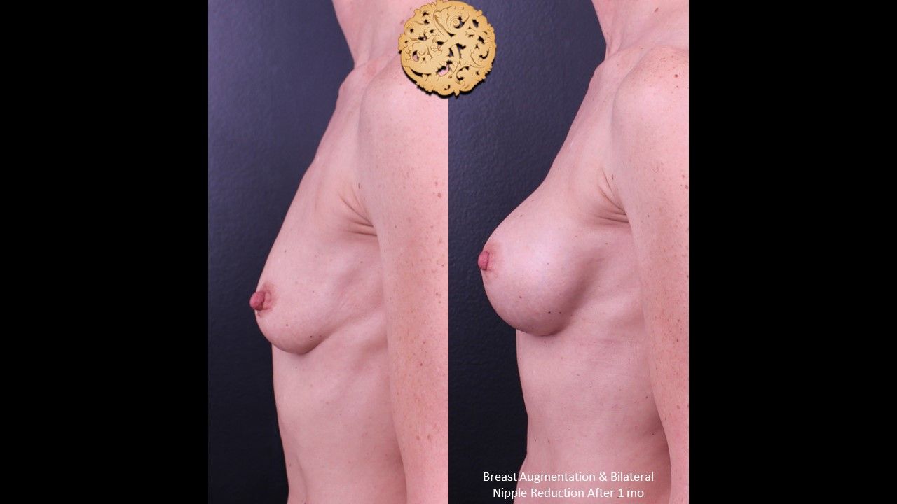 Breast Augmentation before and after - after
