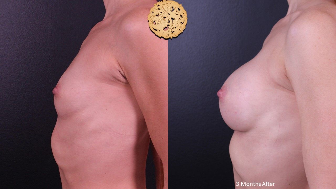 Breast Augmentation before and after - before