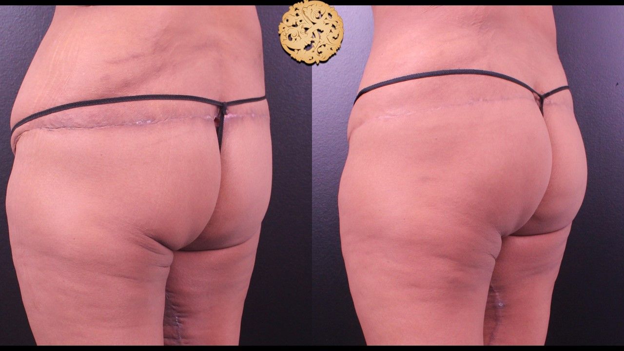 Brazilian Butt Lift before and after - after