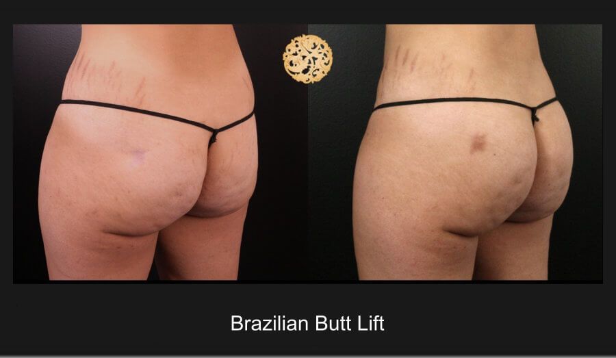 Brazilian Butt Lift before and after - before