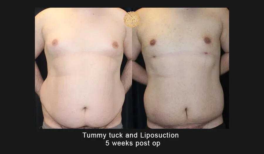 Tummy Tuck before and after - after