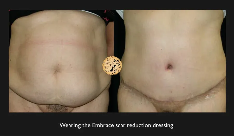 Tummy Tuck before and after - before