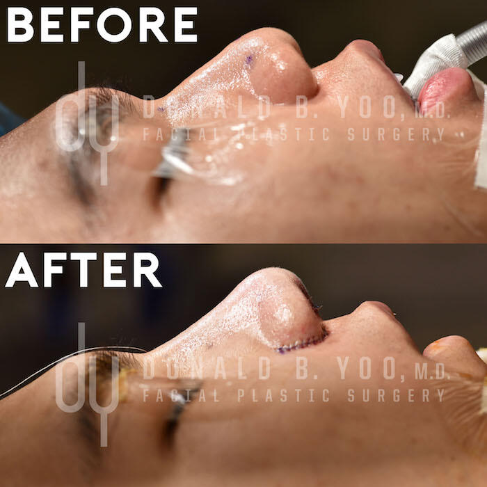 Rhinoplasty before and after - after