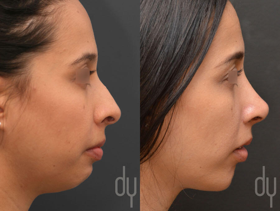 Rhinoplasty and Chin Augmentation before and after - after