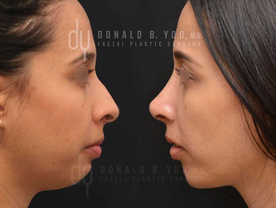 Rhinoplasty and Chin Augmentation before and after - before