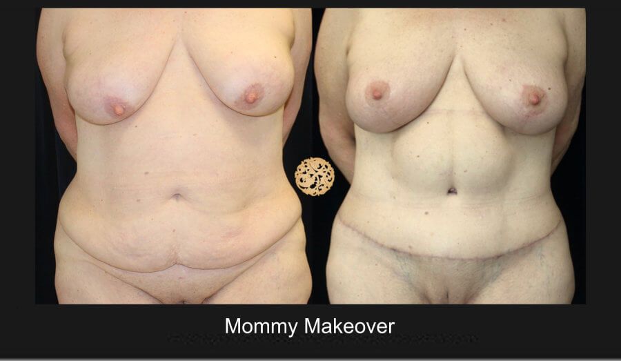 Mommy Makeover before and after - after