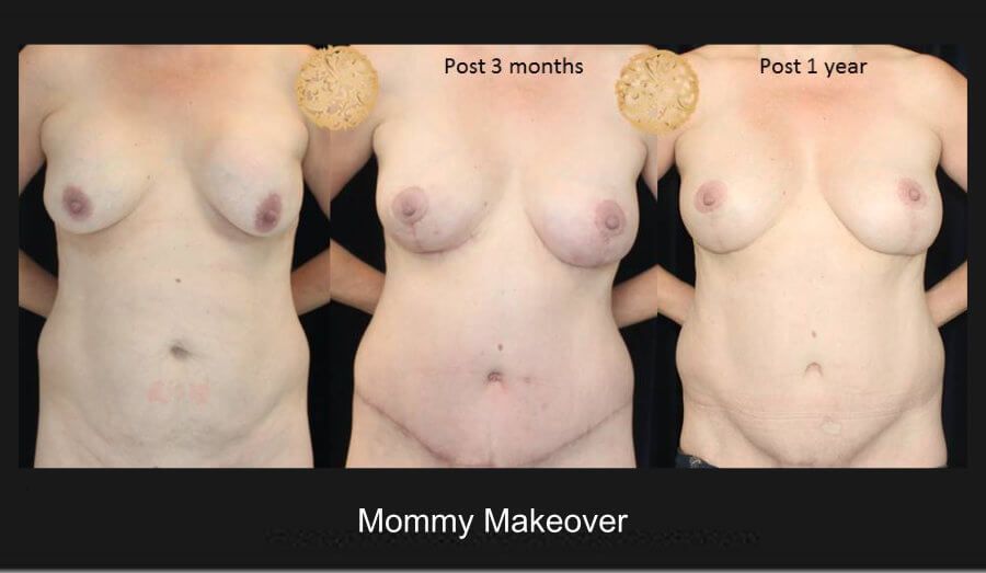 Mommy Makeover before and after - before