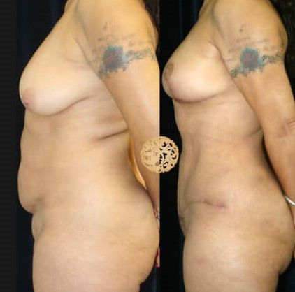 Mommy Makeover before and after - before