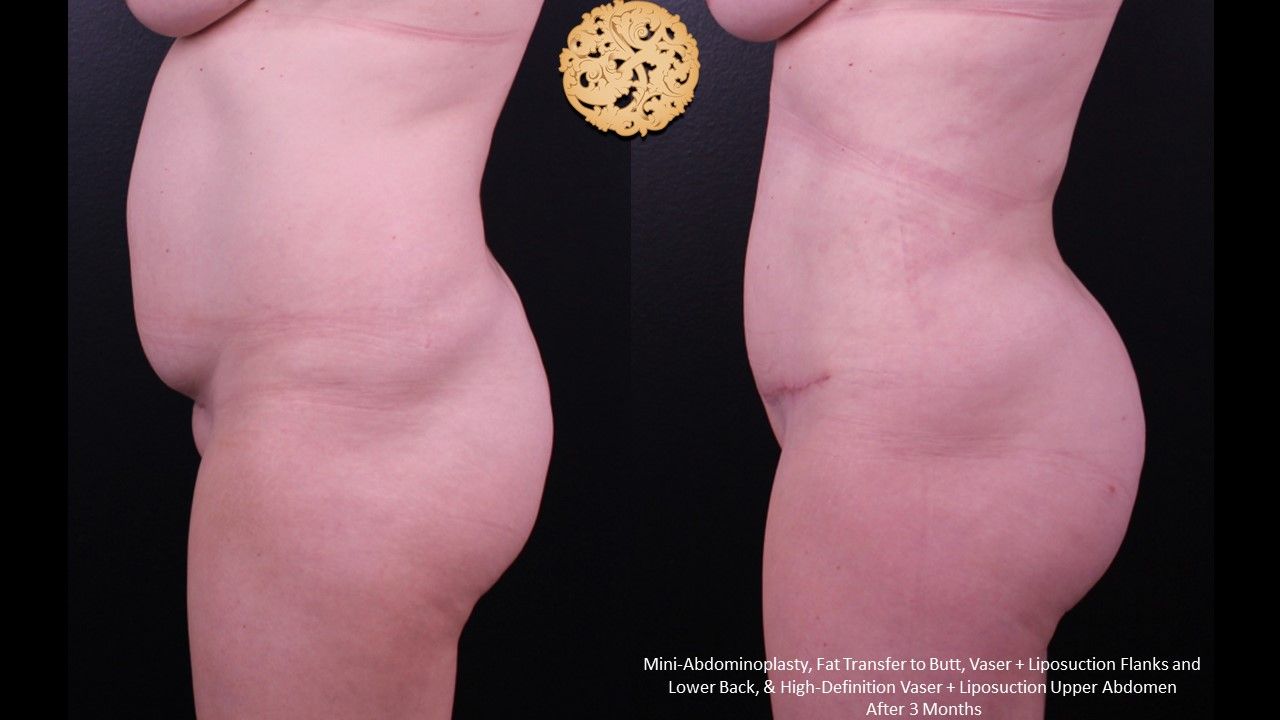 Tummy Tuck before and after - before