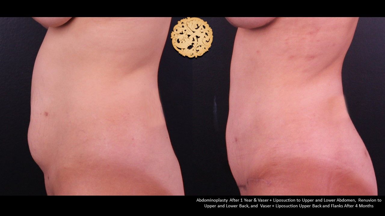 Tummy Tuck before and after - after