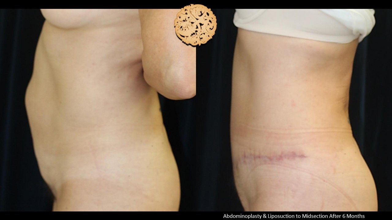 Tummy Tuck before and after - before