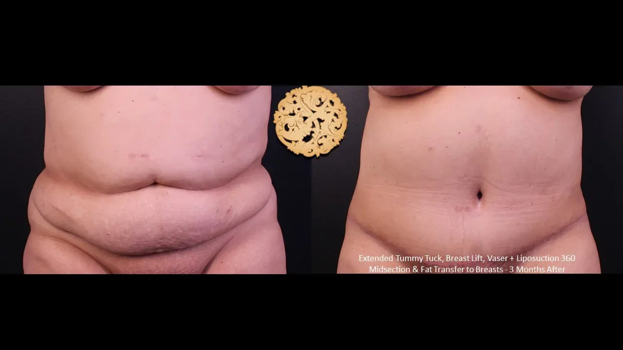 Tummy Tuck before and after - after