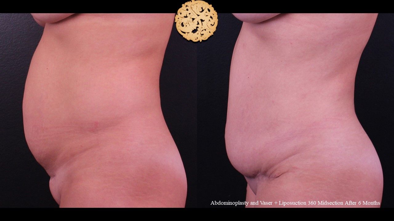 Tummy Tuck before and after - before